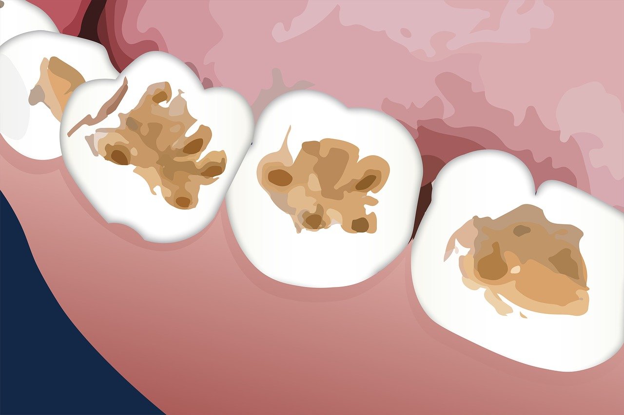 Cómo funciona el mordente en la técnica de restauración dental
